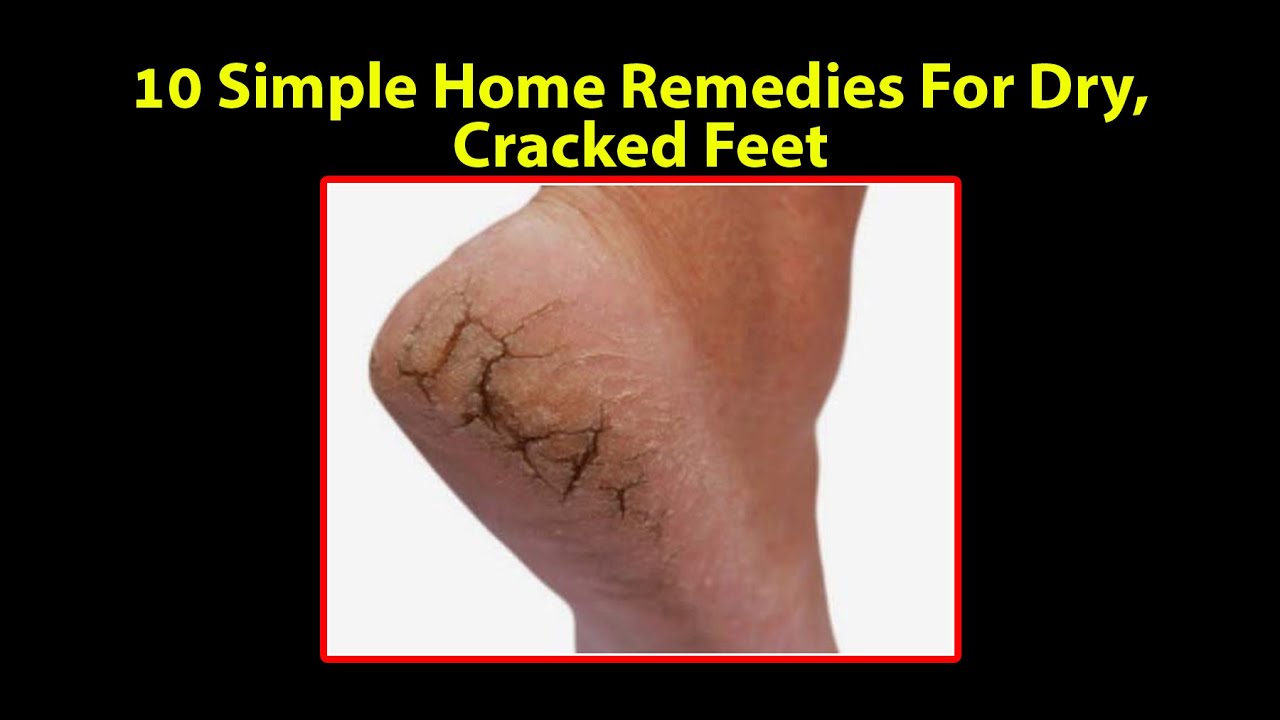 Home Remedy For Dry Cracked Feet